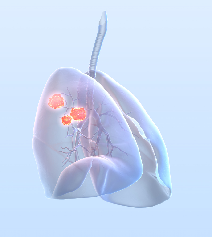 Lung cancer, medically 3D illustration